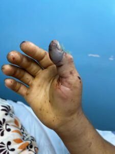 Adbelardo Nieves de 25 años fue mordido por una serpiente Rabo Amarillo
Está recluido en el Hospital Chiquinquirá donde le han administrado 5. Kits de sueros antiofídico. (Foto: Cortesía)